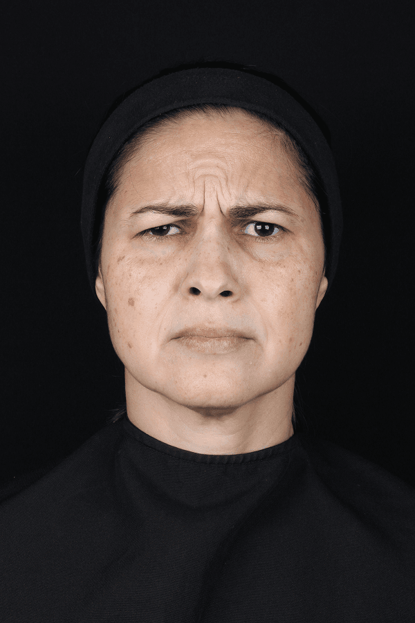 Toxina Botulínica - Antes