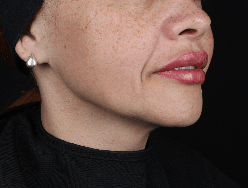 Preenchimento Labial - Depois