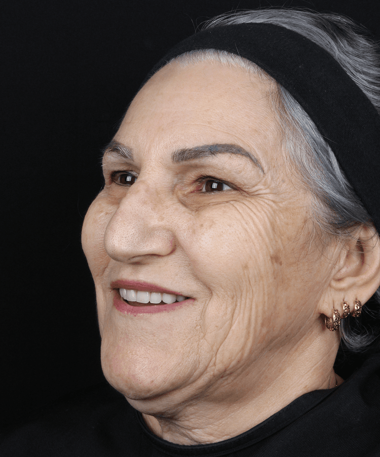 Preenchimento Facial - Antes